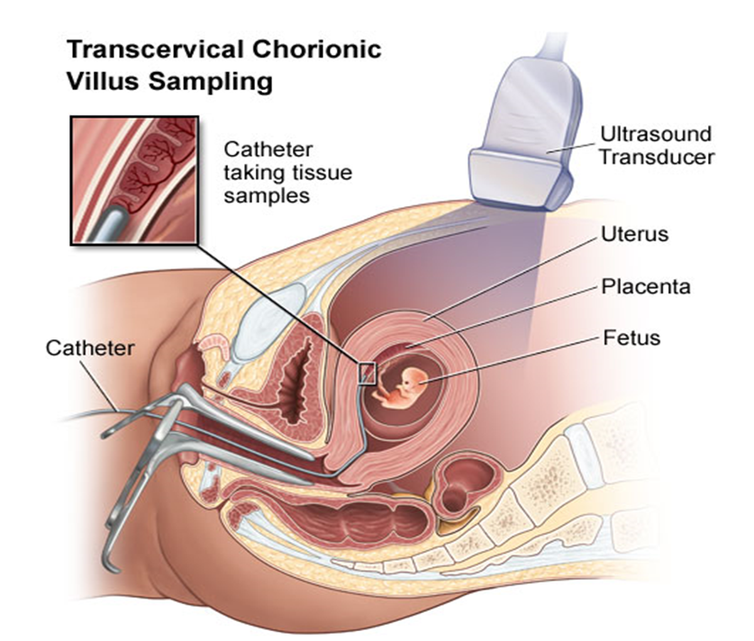 Chorionic Villus Sampling (CVS)