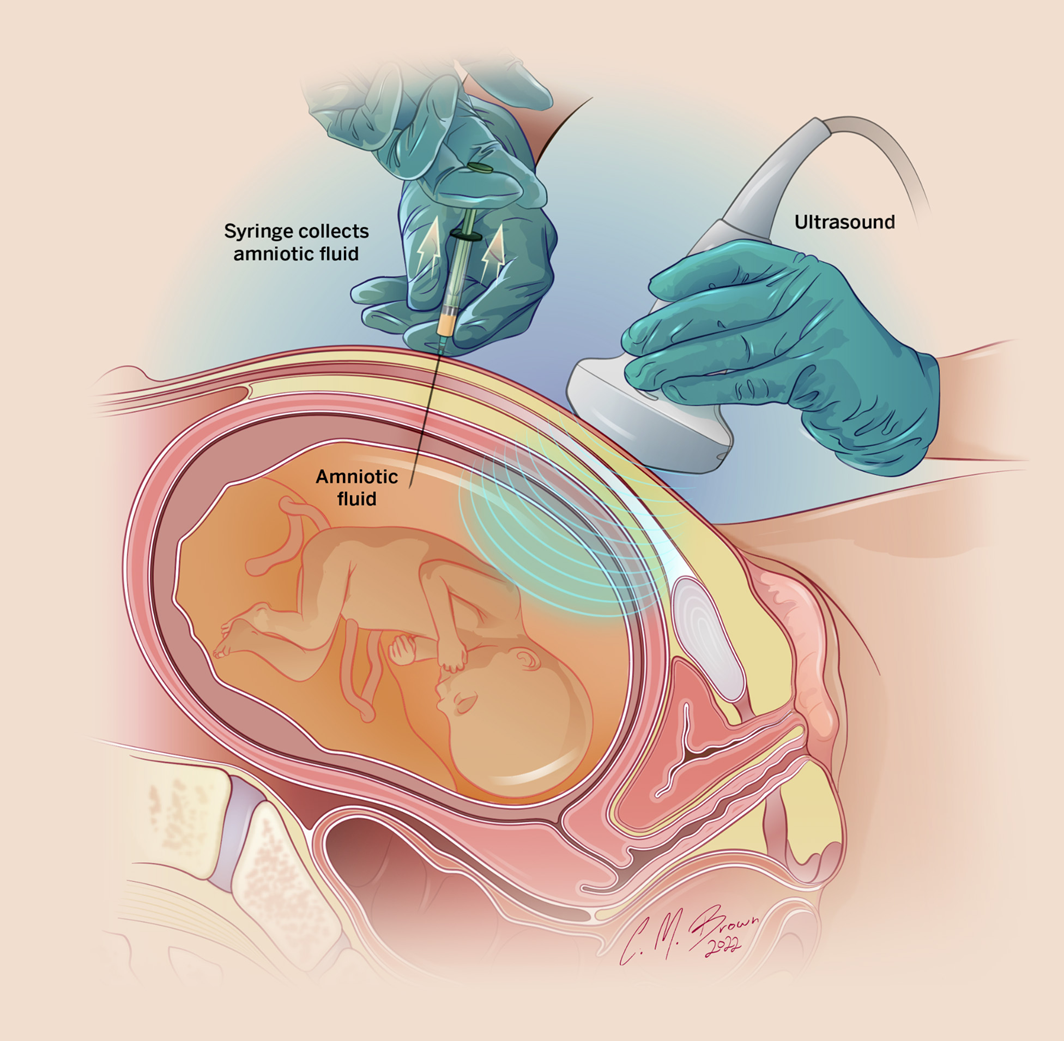 Amniocentesis Procedure